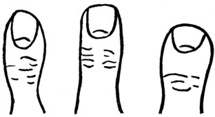 Fig. 4.—THE WAIST-LIKE THUMB. Fig. 5.—THE STRAIGHT THUMB. Fig. 6.—THE ELEMENTARY THUMB.